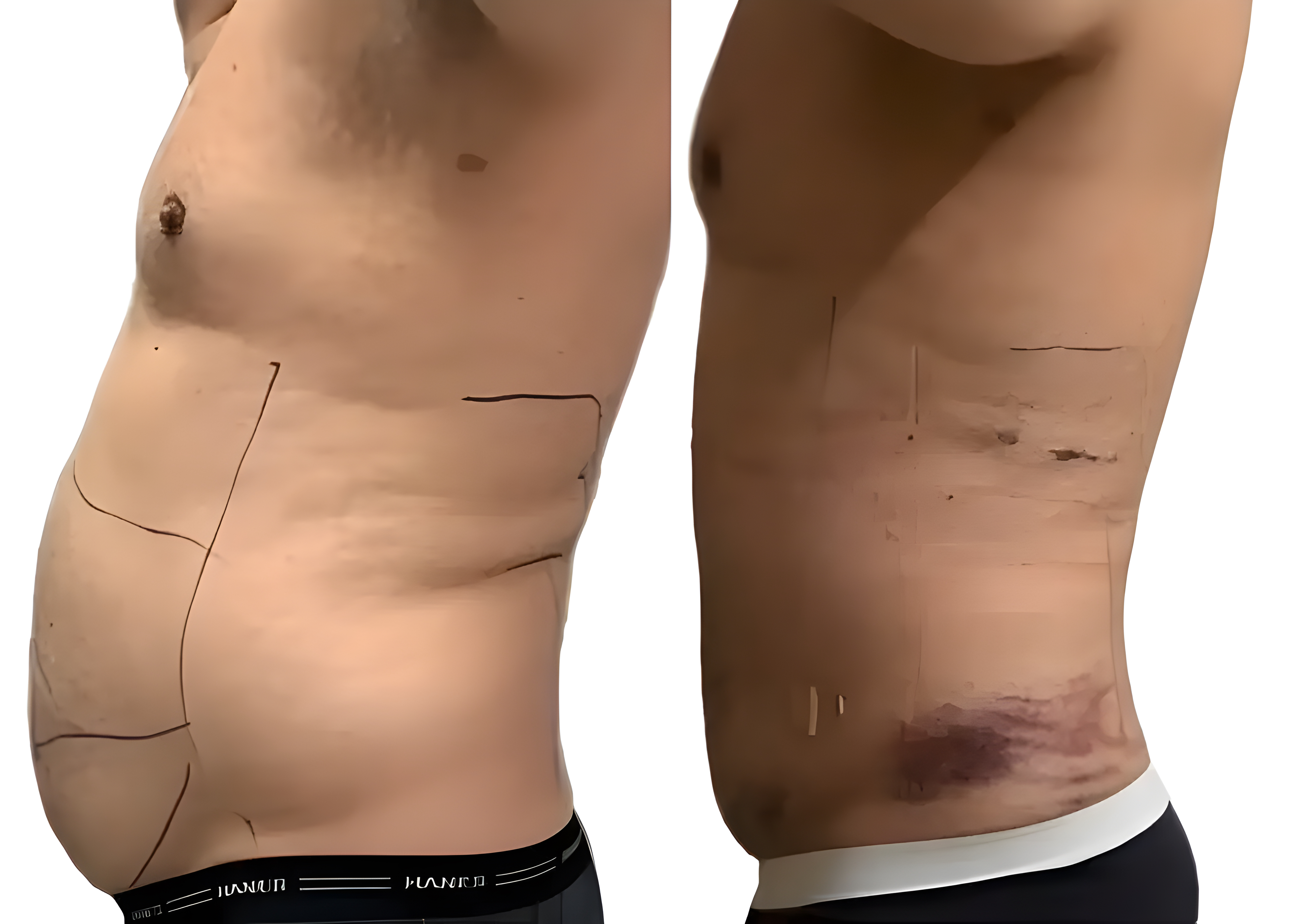Before: Flank and Abdomen Reduction